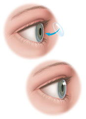Corneal Transplant Dry Eye Treatment | Brooklyn Heights