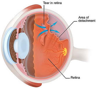 Retinal Tear and Detachment Treatment Brooklyn Heights