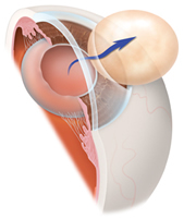 Cataract Surgery | Toric IOLs | YAG Capsulotomy | Brooklyn Heights