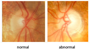 Glaucoma Treatment Brooklyn Heights