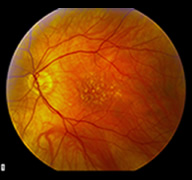 Macular Degeneration Treatment Brooklyn Heights